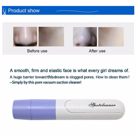 Blackheads & Acne Sucker Remover